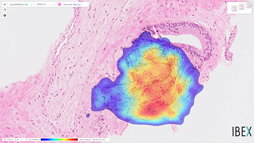 Ibex Galen Prostate AI solution